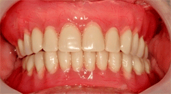 Повні знімні зубні протези