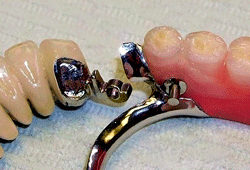 Частково знімні зубні протези