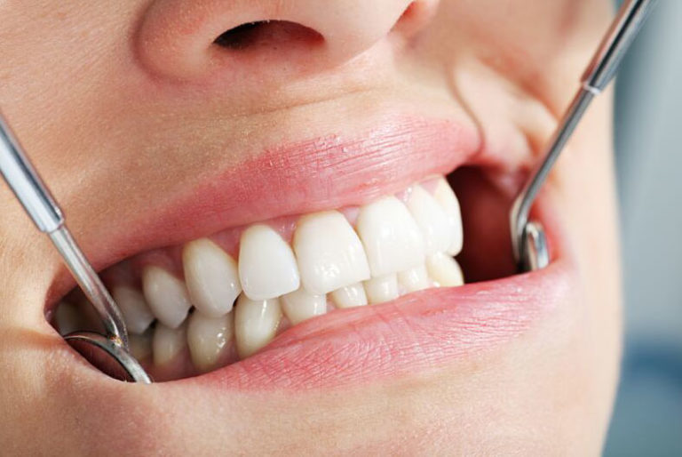 Незнімне протезування зубів